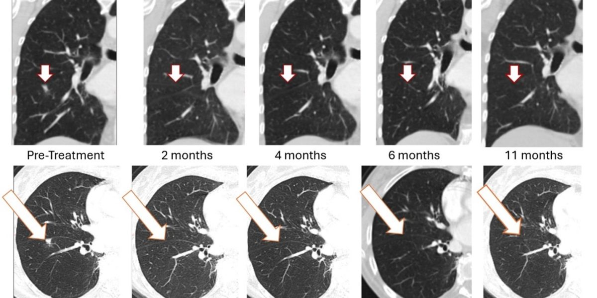 BriaCell Receives FDA Clearance to Initiate Bria-BRES+™ Clinical Study in Breast Cancer
