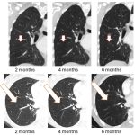 BriaCell Receives FDA Clearance to Initiate Bria-BRES+™ Clinical Study in Breast Cancer