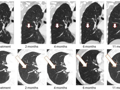 BriaCell Receives FDA Clearance to Initiate Bria-BRES+™ Clinical Study in Breast Cancer