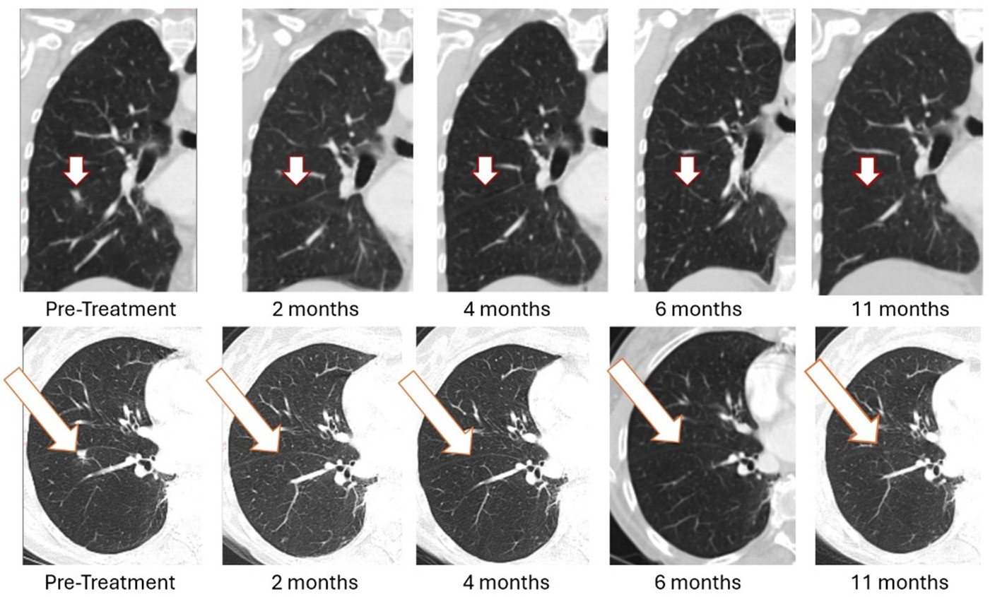 BriaCell Receives FDA Clearance to Initiate Bria-BRES+™ Clinical Study in Breast Cancer